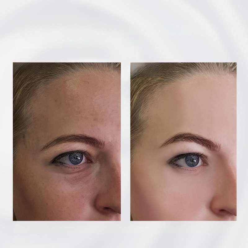 Prima e dopo trattamento viso: riduzione macchie scure e rughe, pelle più liscia e uniforme. Risultati visibili, cura della pelle efficace.