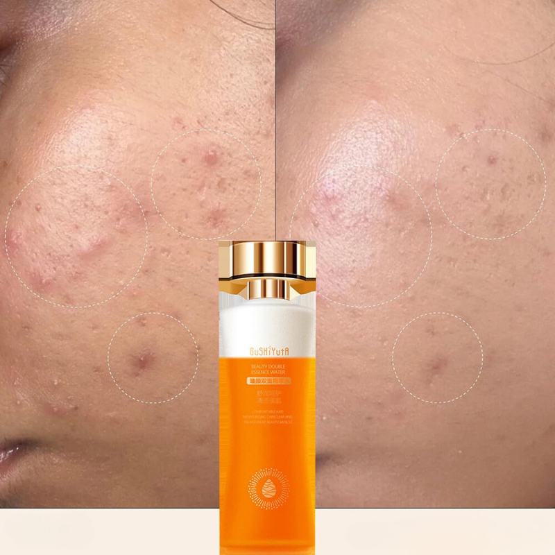 Bottiglia di siero per il viso con effetto anti-acne, prima e dopo l'uso su pelle con cicatrici da acne. Trattamento skincare efficace.