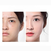 Clearskin ampoule toner - siero per cura dell'acne e idratante-3