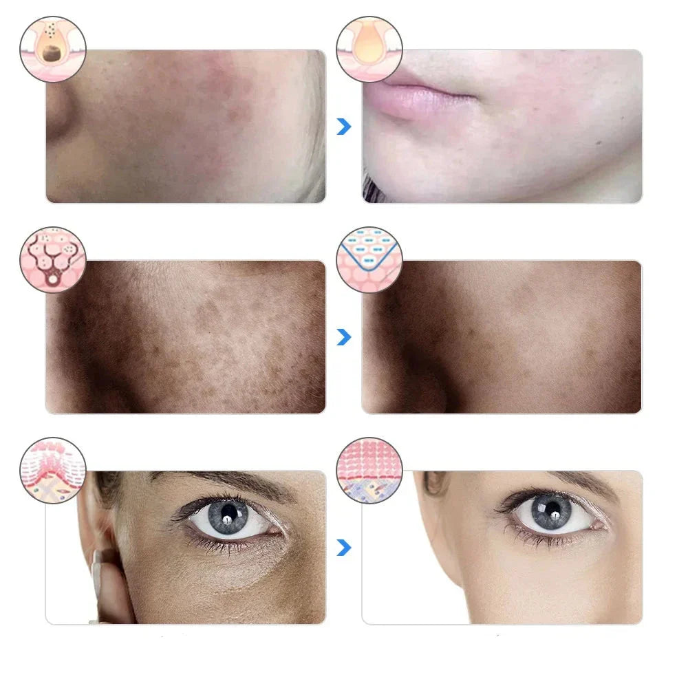 Immagine prima e dopo trattamento pelle: riduzione acne, macchie scure e occhiaie. Risultati visibili, cura della pelle efficace.