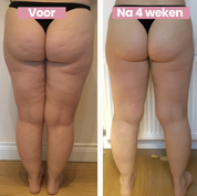 Due foto di gambe femminili prima e dopo 4 settimane di trattamento anticellulite, evidenziano miglioramento della pelle e riduzione della cellulite.