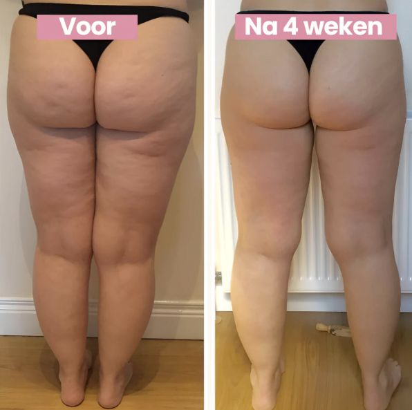 Due foto di gambe femminili prima e dopo 4 settimane di trattamento anticellulite, evidenziano miglioramento della pelle e riduzione della cellulite.