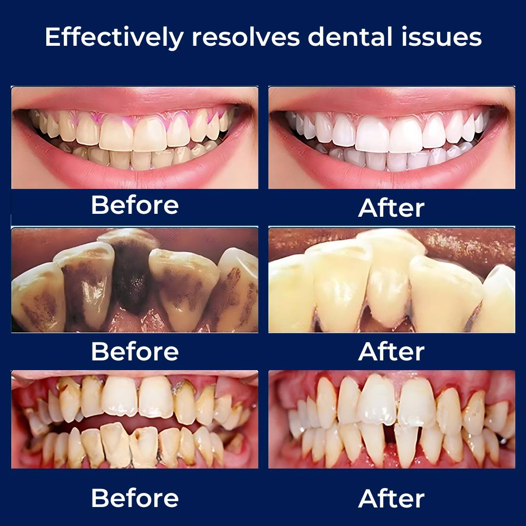 Plaquefree Plaque Remover per denti | Denti ad ultrasuoni Cleaner - Tartar Remover da casa - pulizia dei denti profondi e polacco 2