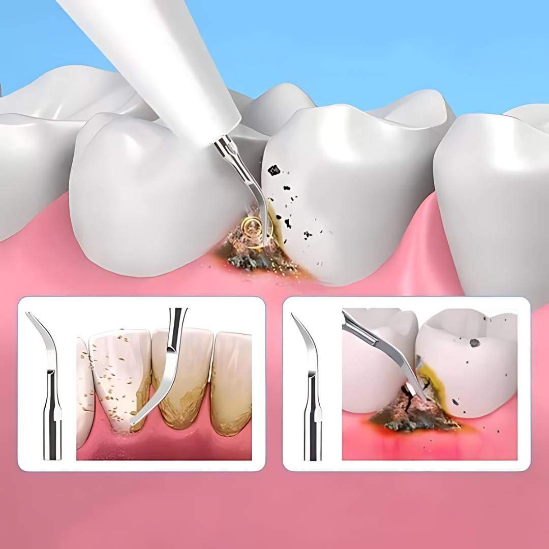 Plaquefree Plaque Remover per denti | Denti ad ultrasuoni Cleaner - Tartar Remover da casa - pulizia dei denti profondi e polacco 4