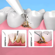 Plaquefree Plaque Remover per denti | Denti ad ultrasuoni Cleaner - Tartar Remover da casa - pulizia dei denti profondi e polacco 4