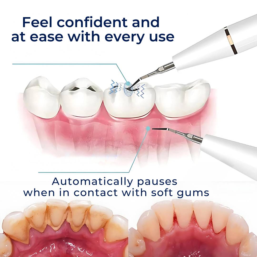 Plaquefree Plaque Remover per denti | Denti ad ultrasuoni Cleaner - Tartar Remover da casa - pulizia dei denti profondi e polacco 6