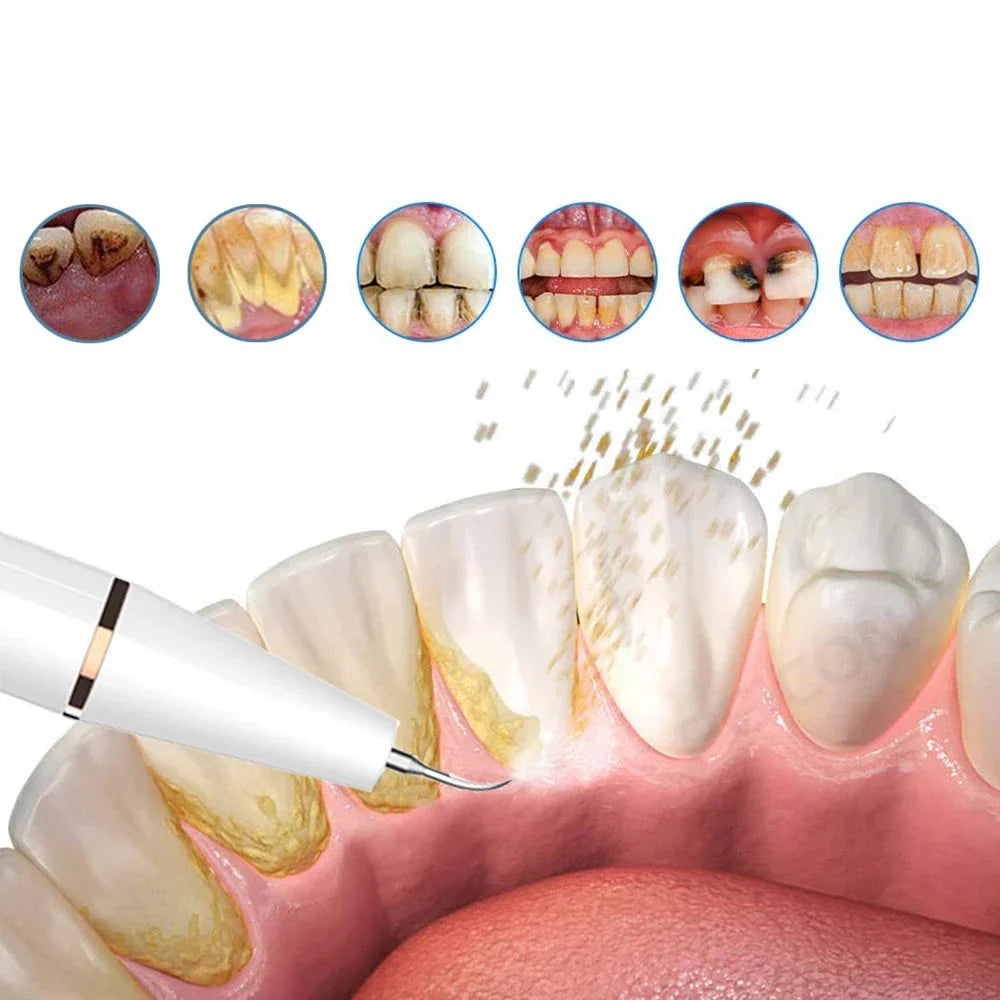 Dispositivo rimozione tartaro dentale, pulizia denti, igiene orale, sbiancamento, cura dentale, placca, gengive sane, strumento elettrico.