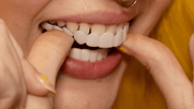 Trasformazione immediata del sorriso con Snap on Smile Veneers 6