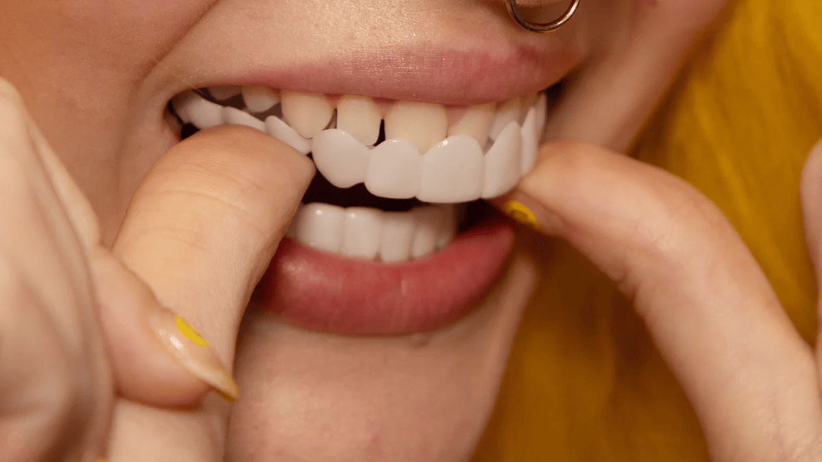 Trasformazione immediata del sorriso con Snap on Smile Veneers 6