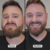 Uomo con barba prima e dopo il trattamento dentale, mostrando miglioramento del sorriso. Trasformazione estetica denti bianchi.
