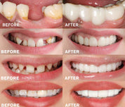 Prima e dopo trattamento dentale, miglioramento estetico dei denti. Immagine di sorrisi con denti restaurati, bianchi e allineati.